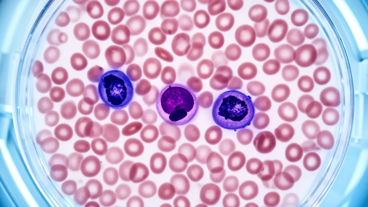 Poziom bazofili przy białaczce: interpretacja wyników i diagnostyka